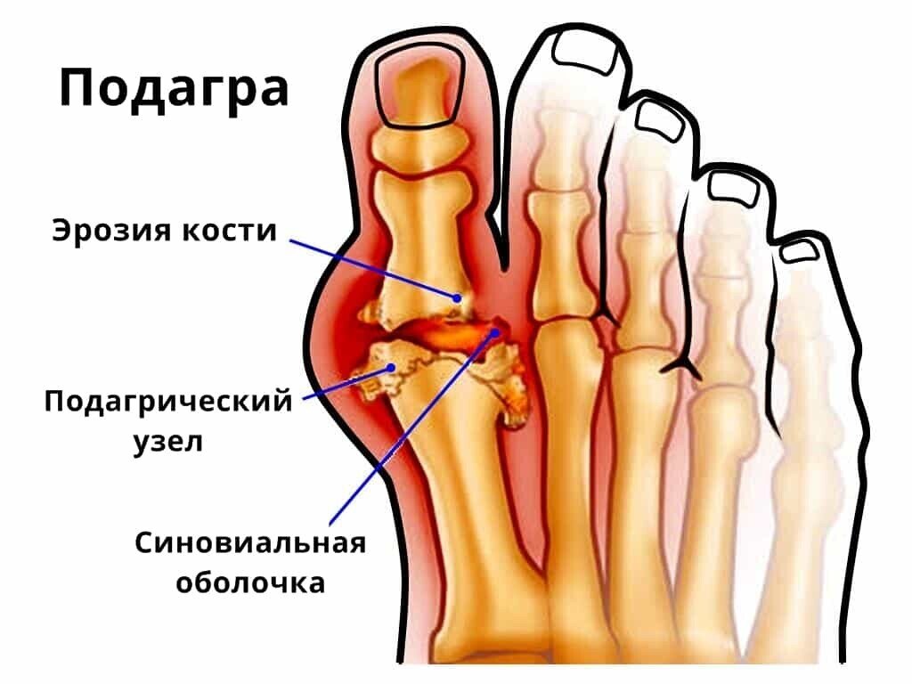 Как избавиться от подагры? | СуперНутри - занимательная нутрициология | Дзен