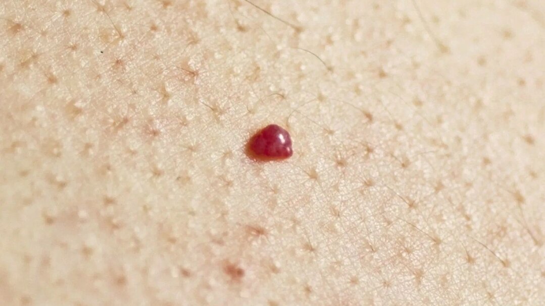 Я убирала вот такую. Она была довольно крупной и цеплялась за одежду 