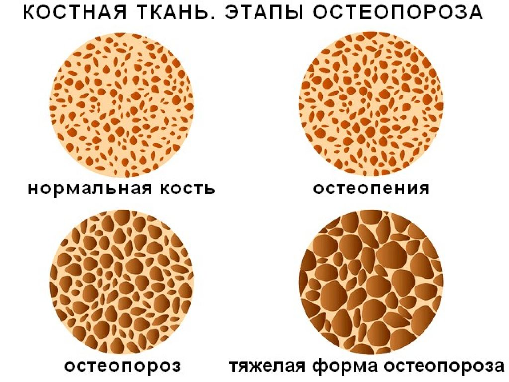 Костной ткани а также. Стадии развития остеопороза. Остеопения и остеопороз. Плотность костной ткани. Костная ткань остеопороз.