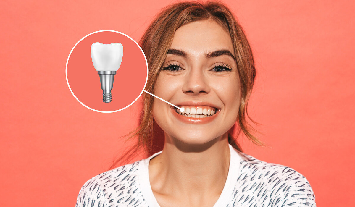 Имплант выглядит как обычный зуб, только вместо обычного корня у такого зуба — титановый