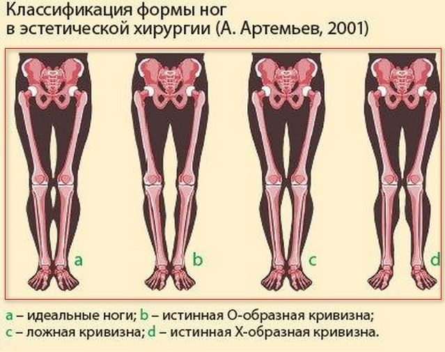 Неидеальные колени: принять или исправить?