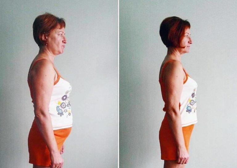 Гормональный лишний вес как сбросить. Похудевшая женщина. Похудение до и после. Похудение после гормонов. Гипотиреоз фигура женщины.