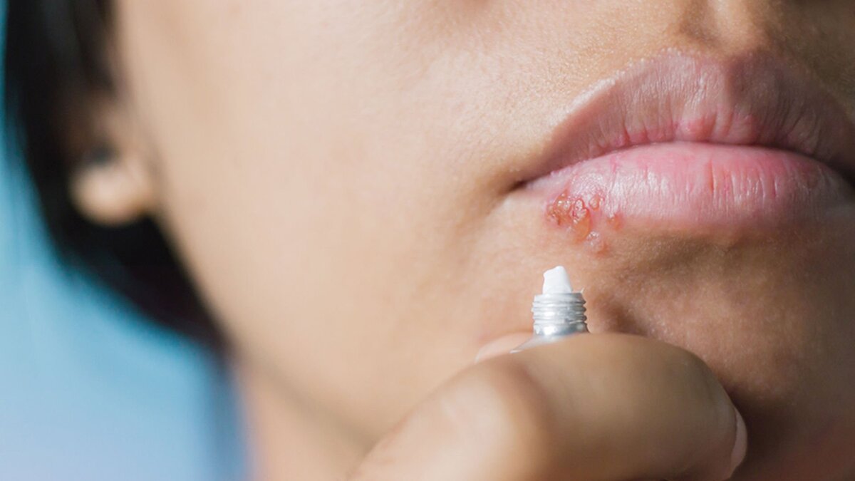 Герпес на лице, и не только. Источник: https://orimos.ru/gerpes-na-lice-priciny-vidy-simptomy-lecenie-posledstvia/