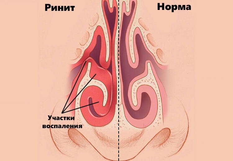 Фото с сайта https://kingmed.info/articles/Obshchaya_vrachebnaya_praktika/Otorinolaringologiya/article_255/Ostriy_rinit_Prichini_klassifikatsiya_ostrogo_rinita_Diagnostika_i_lechenie_ostrogo_rinita