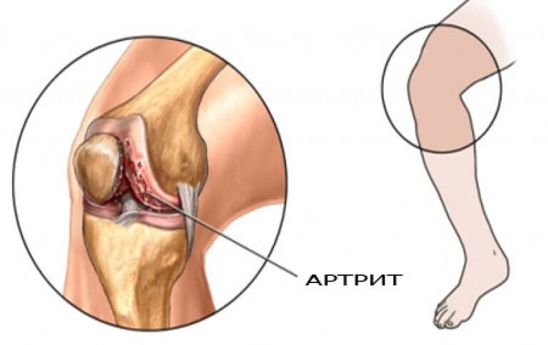 Артрит коленного сустава картинки