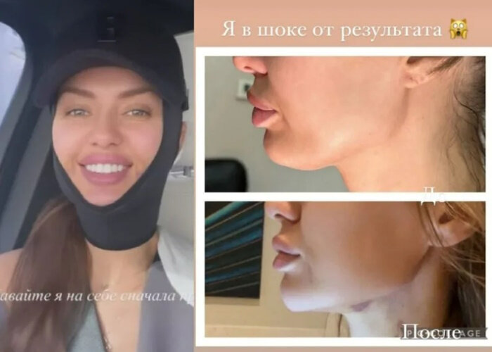 Телеведущая Виктория Боня показала губы и нос после пластики