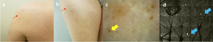 Очаги поражения после лечения методом узкополосной UV-B фототерапии:  a. уменьшение количества папулезных очагов поражения на коже левого плеча и b. правого бедра (красные стрелки);
 
c. дерматоскопия очагов поражения на коже плеча (20×): уменьшение количества кератотических пробок (желтая стрелка); d. уменьшение количества фолликулярных кератотических пробок при отражательной конфокальной микроскопии (кожа плеча, синие стрелки).

Первоисточник - Arisi M, Gelmetti A, Zanca A, Rossi M, Lorenzi L, Incardona P, Calzavara-Pinton P, Venturini M. Clinical, Dermoscopic and In-Vivo Reflectance Confocal Microscopy Evaluation of a Case of Graham Little-Piccardi-Lassueur Syndrome Successfully Treated with Narrowband-UVB Phototherapy. Dermatol Ther (Heidelb). 2020 Aug;10(4):887-892.  
https://pubmed.ncbi.nlm.nih.gov/32533553/
