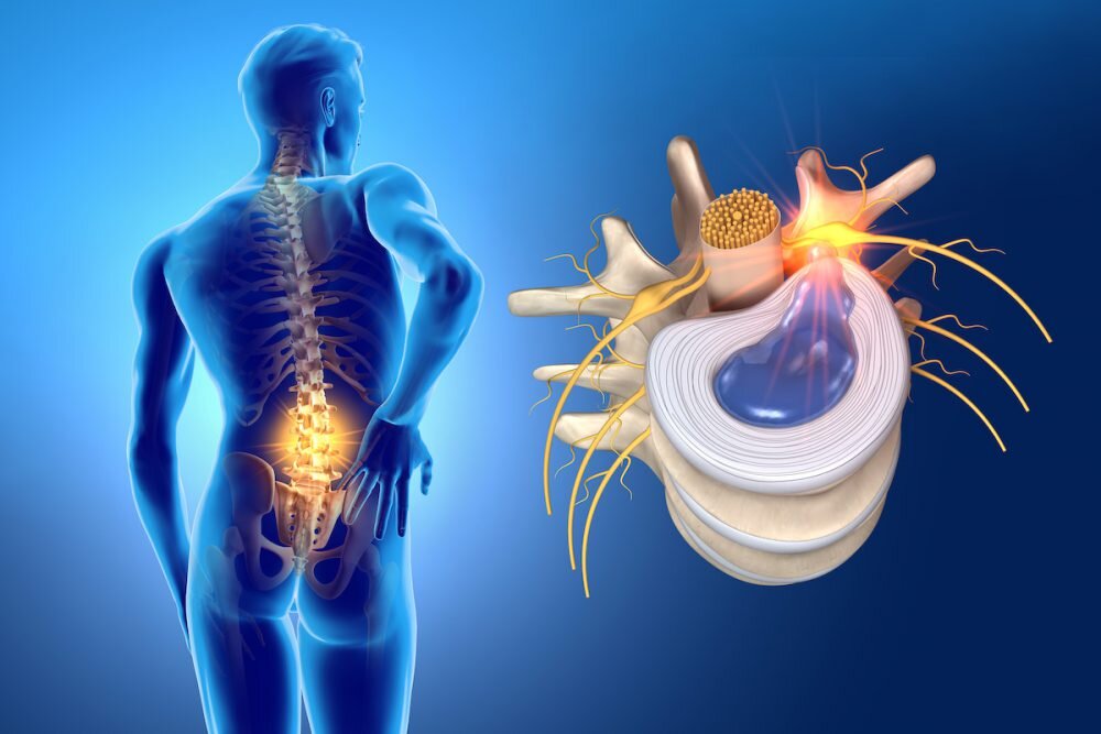 Врач грыжа спина. Реконструкция межпозвоночных дисков. Lumbar Disc. Herniated Disc. Стволовые клетки позвоночник