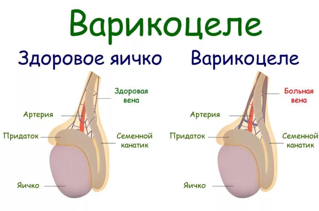 Варикоцеле - симптомы, лечение, операция