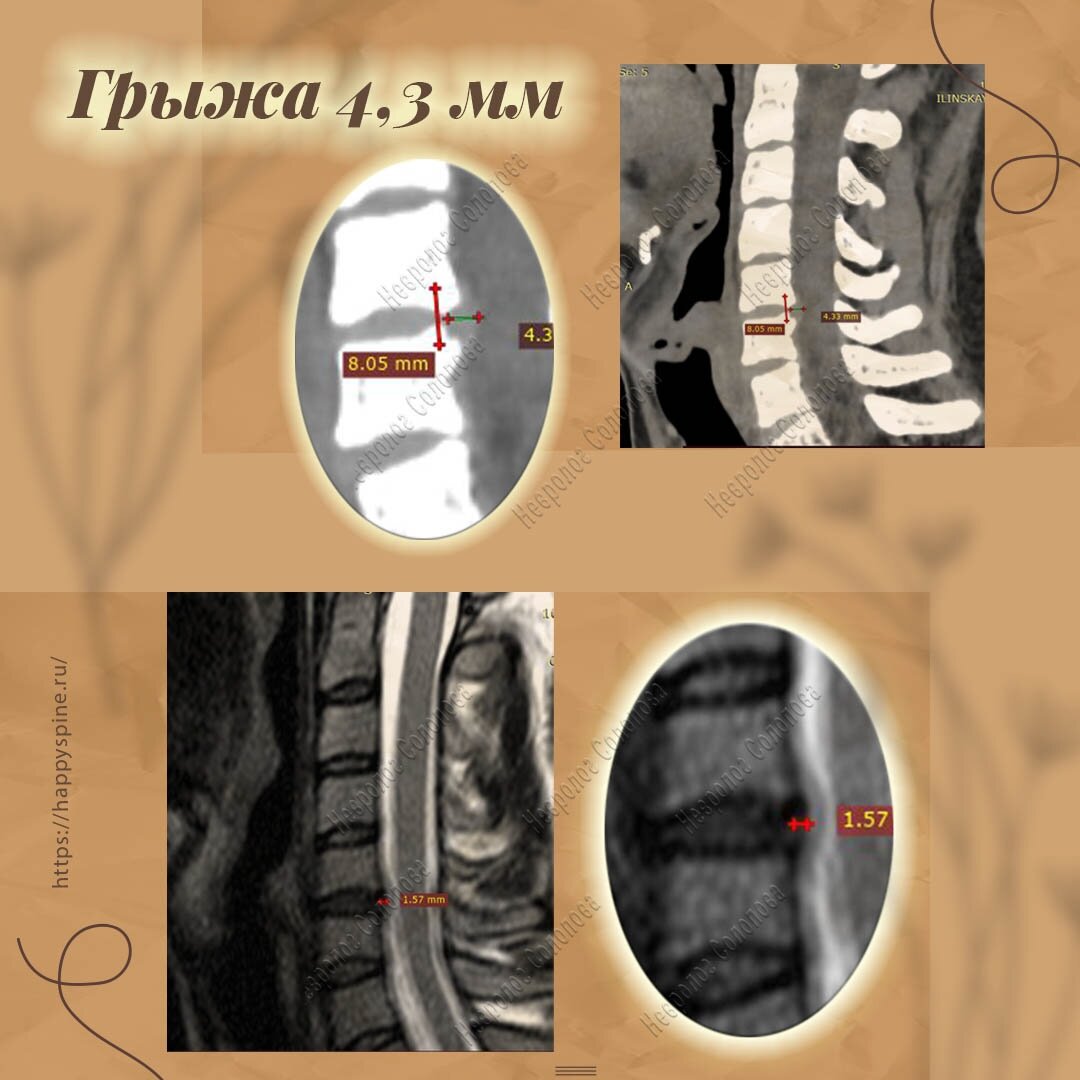 Грыжа 4мм. Грыжа 4 миллиметра. Грыжа диска шейного. Грыжа диска шейного отдела.