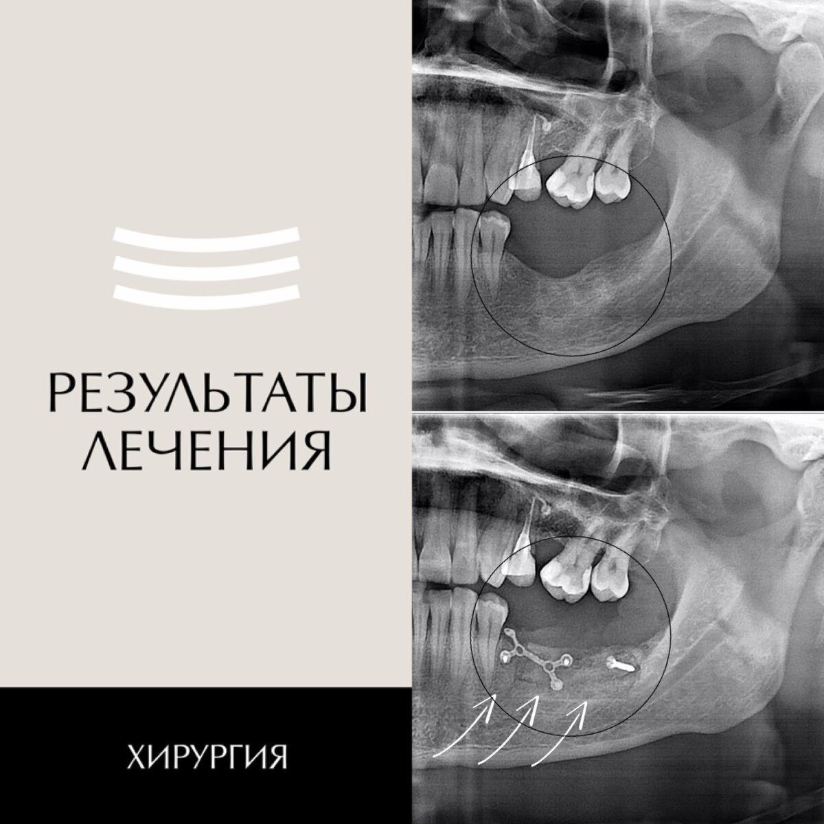 Костная пластика перед имплантацией. Предположительный срок приживления - 5 месяцев