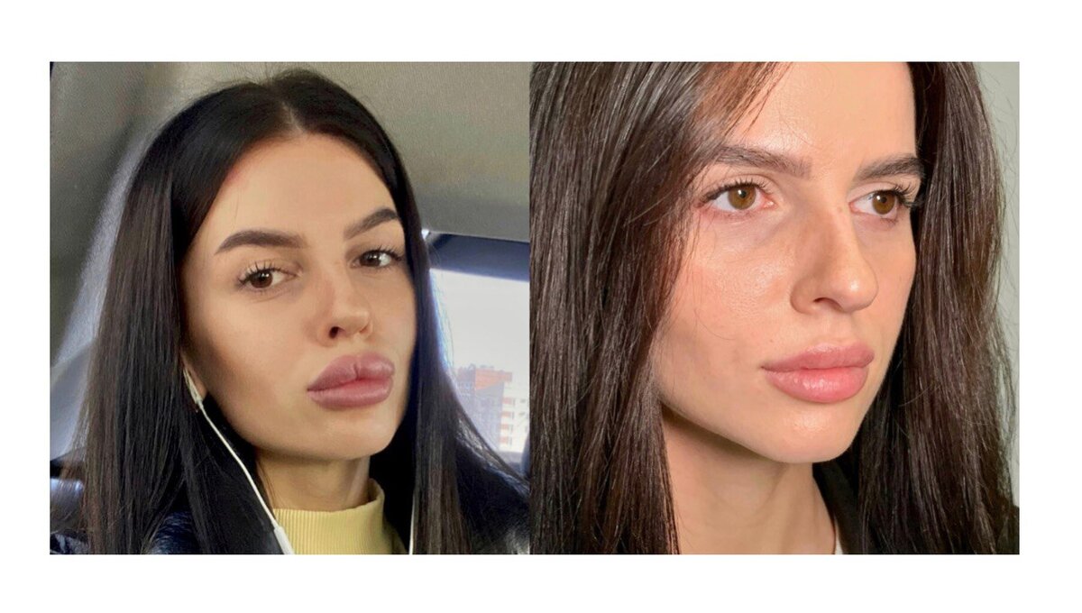 Фото слева - у девушки сместился филлер в губе. Фото справа - после удаления препарата и контурной пластики. Работа А.И. Пацюк.