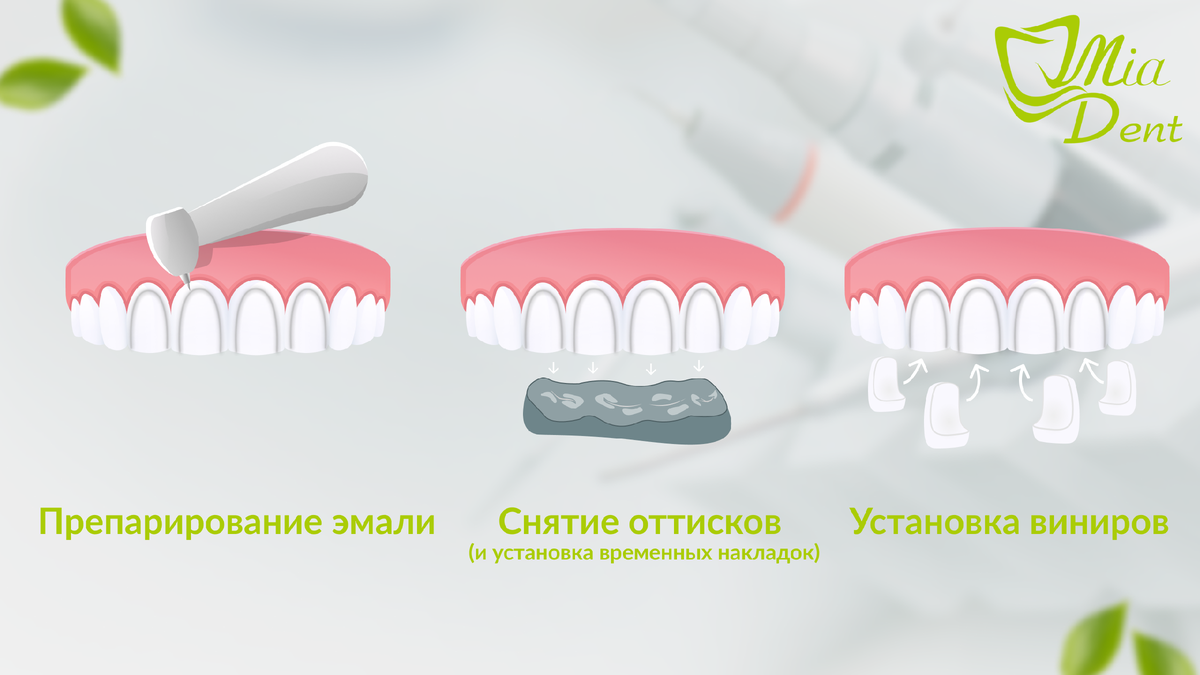 Виниры для зубов технология установки с картинками