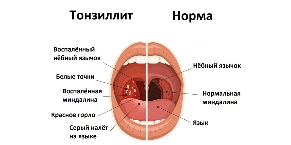 Как вылечить ангину : Здоровье. - Страница 2