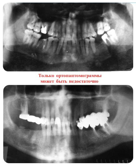 Фото 1, 2: обзорный снимок (ортопантомограмма) — объем информации для планирования имплантации ограничен, возможно оценить с определенной долей погрешности только один параметр — высоту и ориентировочно расположение некоторых анатомических образований или симптомов заболеваний, для первичной консультации данное исследование будет нужным