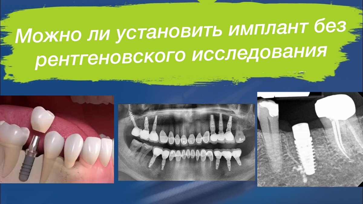 Можно ли установить имплантат без рентгеновского исследования? | Правдивая  стоматология доктора Аболмасова | Дзен