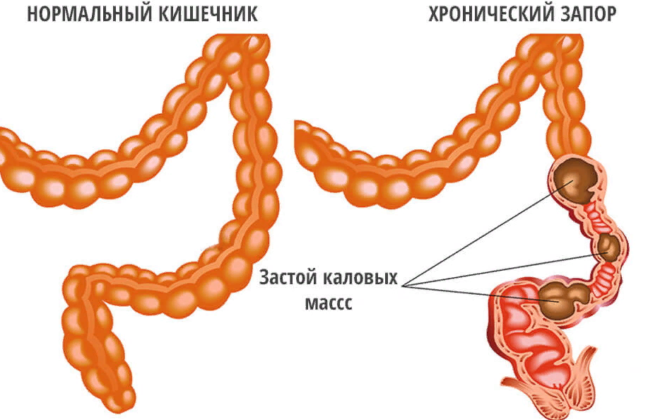 Лечение запоров в домашних условиях