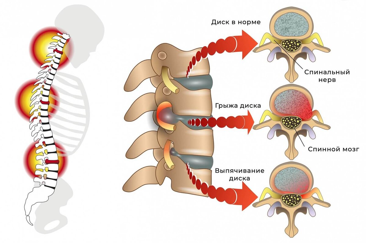 Грыжа позвоночника схема