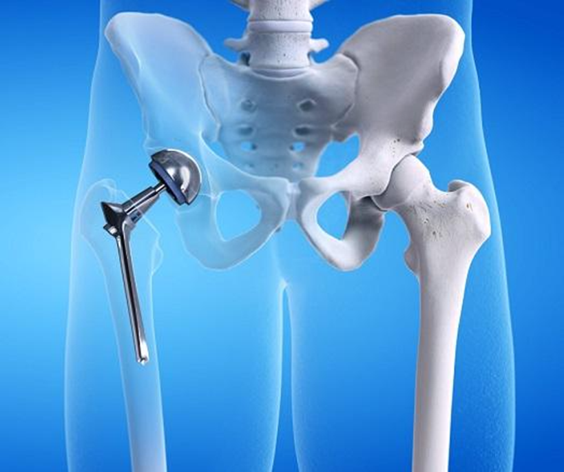 Тотальное эндопротезирование. Артропластика тазобедренного сустава. Эндопротез тазобедренного сустава. Тотальное эндопротезирование тазобедренного сустава кт. Ревизионное эндопротезирование тазобедренного сустава.