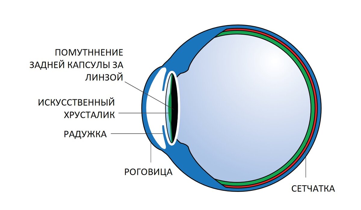 Вторичная катаракта