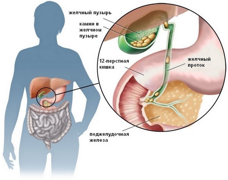 Почему удаляют желчный пузырь: причины и последствия