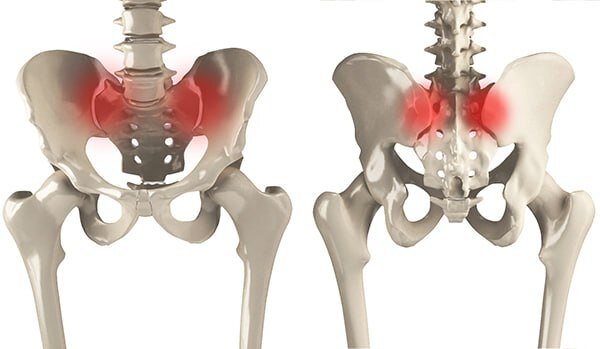 Рентген крестцово подвздошных сочленений сакроилеит артроз. Сакроилеит тазобедренного сустава. Артроз крестцово подвздошных сочленений степени. Артроз крестцово подвздошных сочленений степени. Артроз крестцово подвздошных сочленений степени.