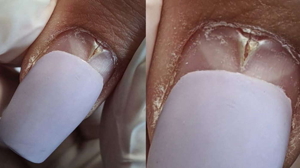 Онихорексис. 