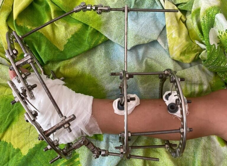    Оренбургские хирурги-травматологи выполнили операцию на ноге 5-летнему малышу Кристина Просвиркина