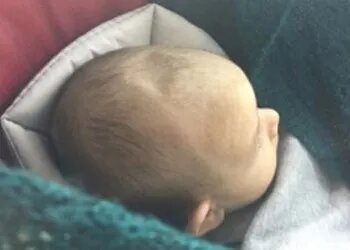 Родничок у новорожденных детей: Анатомия, Функции и Клиническое ...