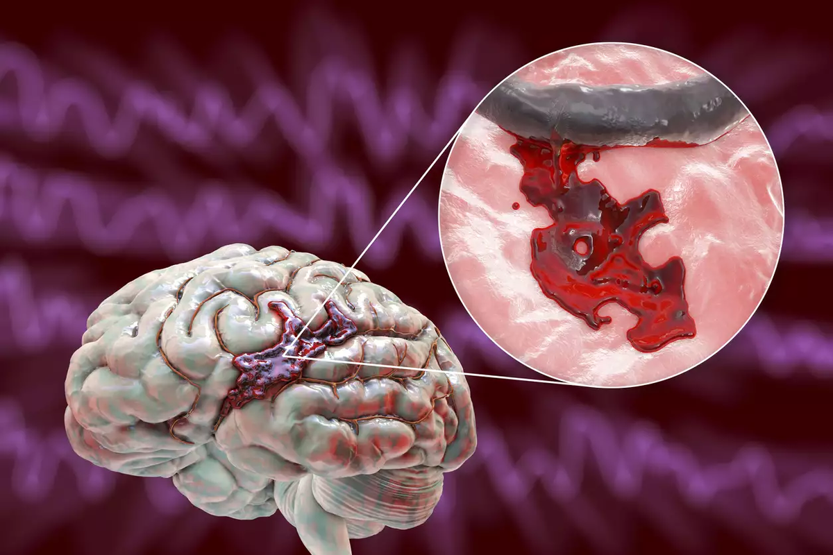 Кровоизлияние ствола мозга. ОНМК геморрагический инсульт. Геморрагический инсульт кровоизлияние в мозг. Геморрагический инсульт с кровоизлиянием в головной мозг. Геморрагический инсульт разрыв сосуда.
