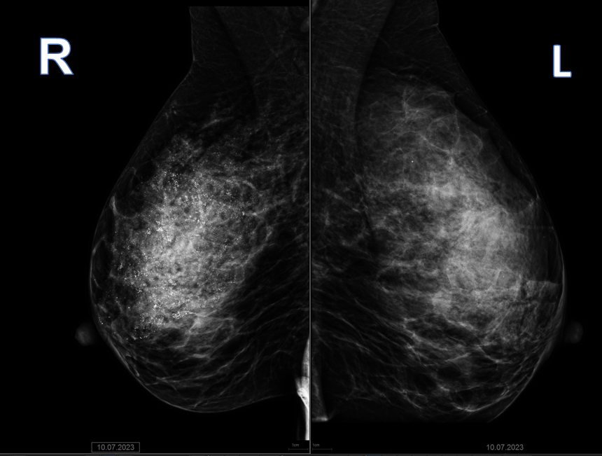 Рис. 1 Маммограммы правой и левой молочной железы в косой проекции R MLO и L MLO, в правой молочной железе – множественные тени кальцинатов по типу слепков протоков.
