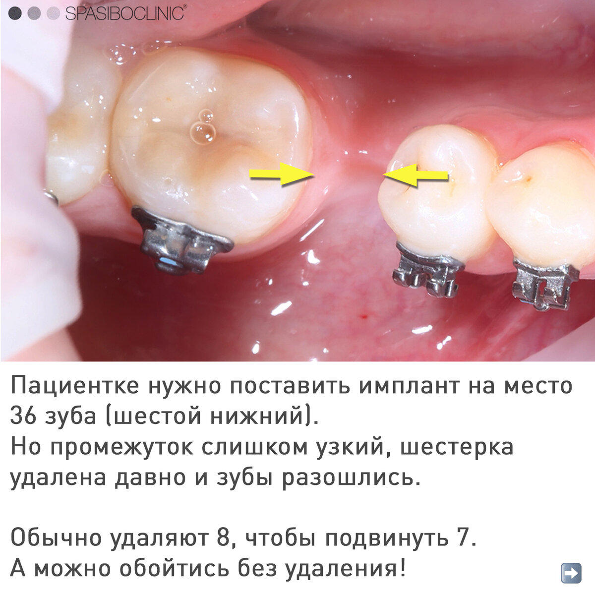 Можно ли поставить брекеты на несколько зубов?