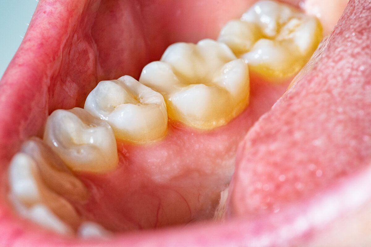 Биопленка — это налет из микроорганизмов на зубной поверхности. Иногда ее даже можно почувствовать языком на ощупь (она шероховатая), иногда — увидеть невооруженным глазом (желтые пятна на зубах).  
Фото: Shutterstock
