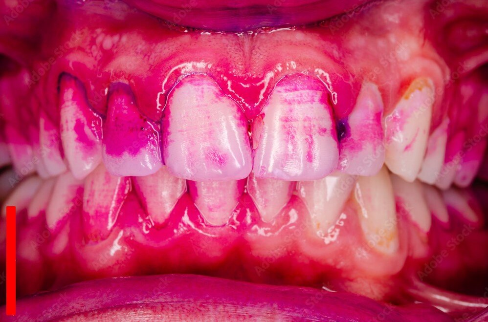 окрашенные участи зубов-зубной налёт