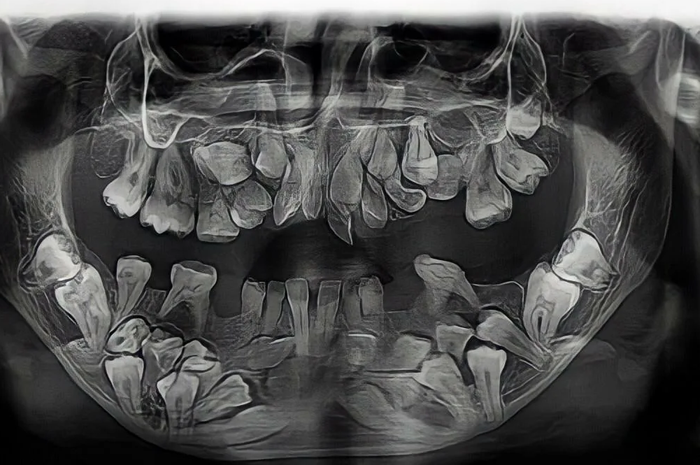 Аномалии удаления. Гипердонтия зубов рентген. Сверхкомплектные зубы аномалия. Сверхкомплектные зубы рентген.