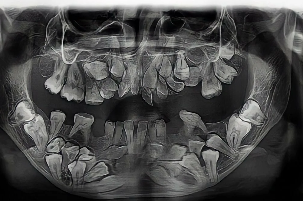 Двойная челюсть у человека. Гипердонтия зубов рентген. Сверхкомплектные зубы аномалия. Сверхкомплектные зубы рентген. Гипердонтия (сверхкомплектные зубы.