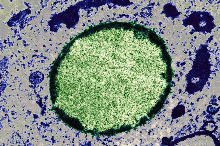 Микрофотография ядра клетки мозга с реплицирующимся вирусом кори Фото: Mike Kayser / Wellcomeimages.com