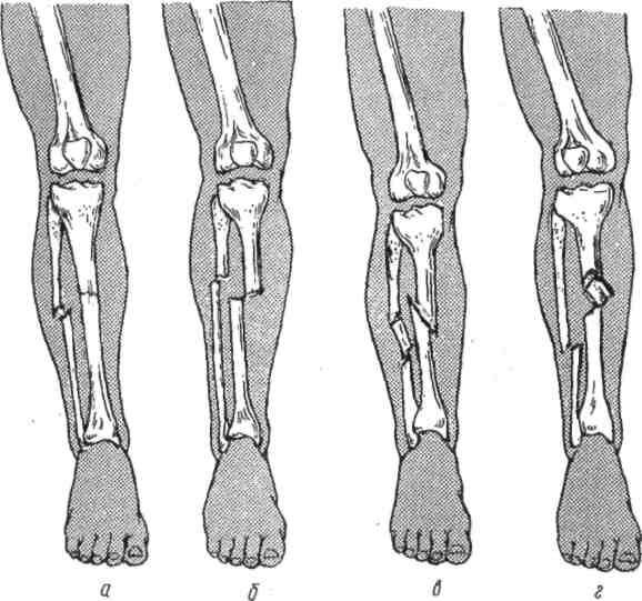 Клиническая картина переломов нижних конечностей