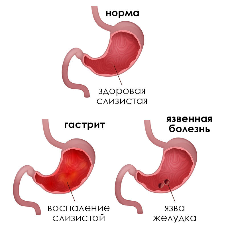 Ведущими причинами возникновения язвенной болезни являются