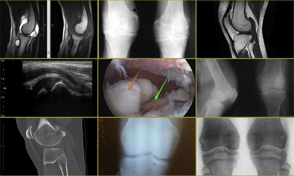 Гемартроз коленного сустава мрт. Синовит коленного сустава на кт. Разрыв мениска коленного сустава рентген.