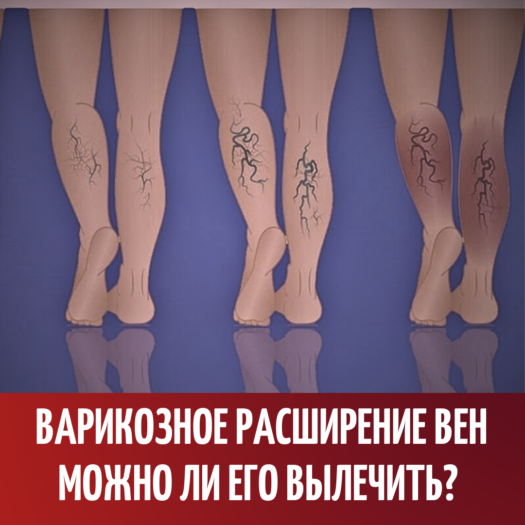 Варикозное расширение вен. Можно ли его вылечить?! | Реабилитация ...