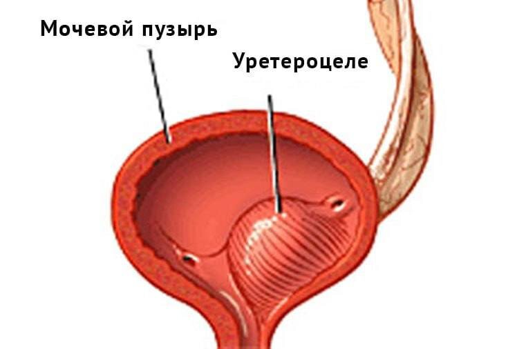 Уретроцеле у женщин фото