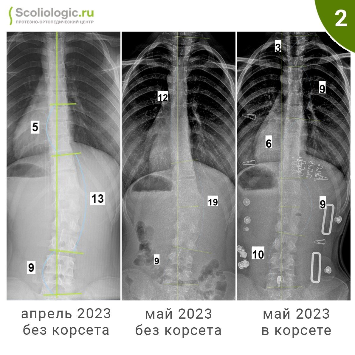 Лечение сколиоза II степени | Протезно-ортопедический центр | Дзен