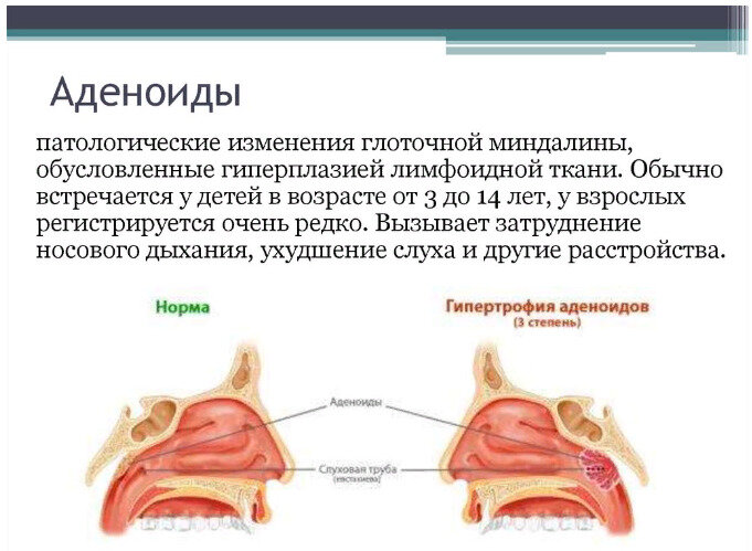 Бронхит у детей