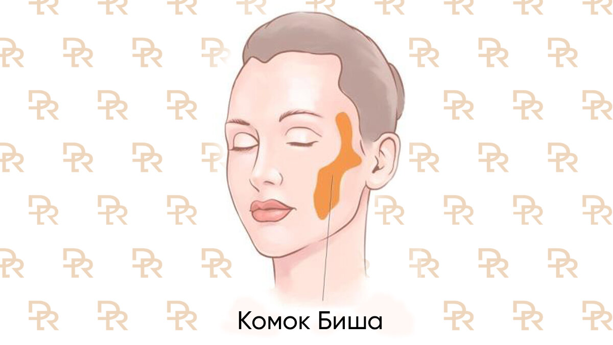 Где находятся комки биша на лице схема