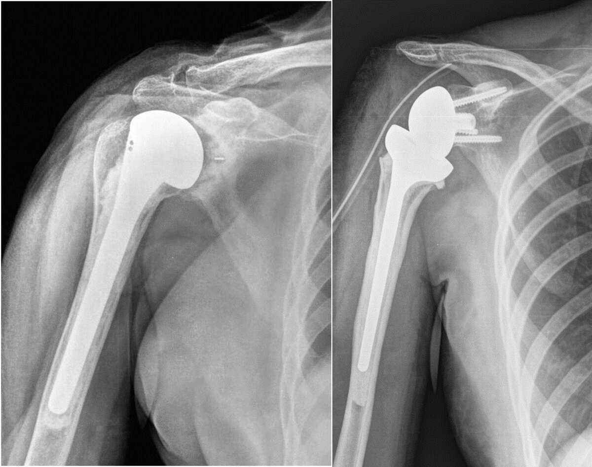 Эндопротезирование плеча: ответы на главные вопросы | Новосибирский НИИТО |  Дзен
