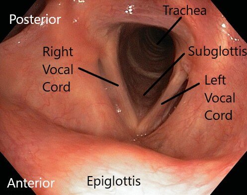 Эндоскопическая картина гортани. Фото из открытых источников.