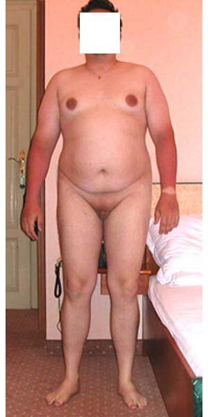 Микропенис