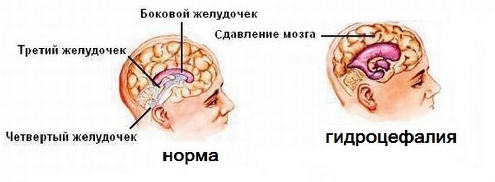 Повышенное внутричерепное давление (ВЧД) у детей - симптомы, диагностика, лечение