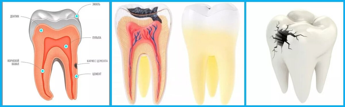 Как уменьшить боль в зубе. Строение зуба кариес пульпит. Шестерка пульпит корня.
